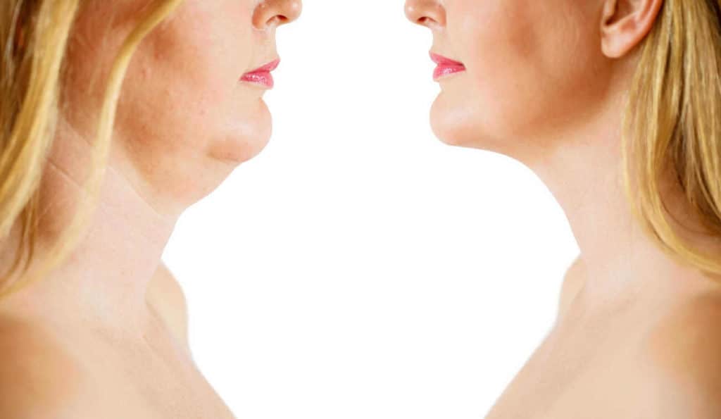 Double Chin treatment Byfleet before and after results