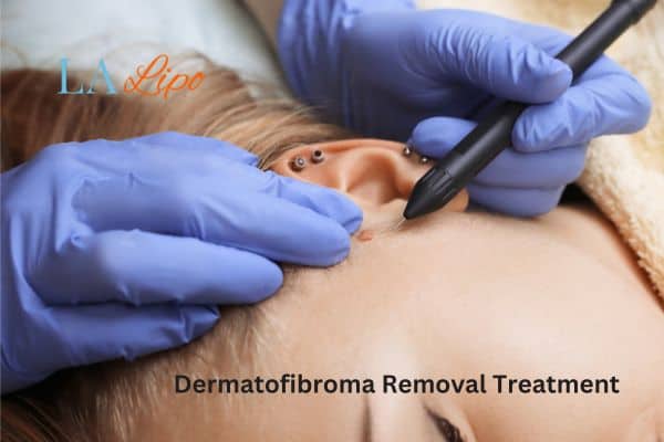 Dermatofibroma Removal Treatment Byfleet