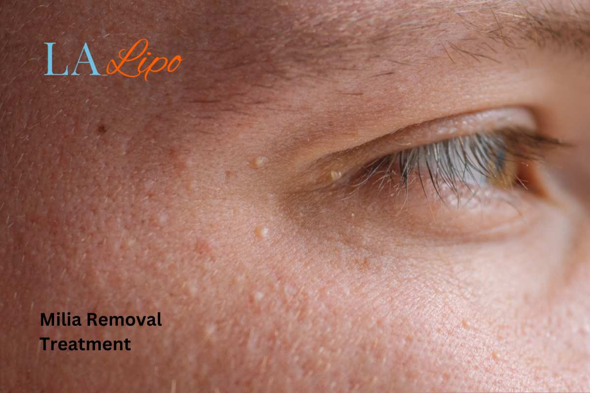 Cryopen Milia Removal: Is It the Easiest and Safest Option Byfleet?
