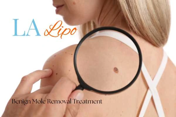 Why getting moles removed Byfleet can boost your confidence!