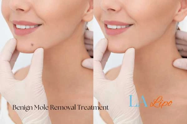 Woman's before and after results of being moles removal treatment Byfleet