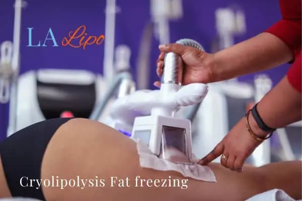 women getting fat freezing Byfleet