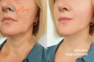 hi-fu for wrinkles Byfleet before and after results