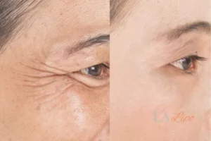 Before and after results of woman - HI-fu wrinkles reduction treatment Byfleet