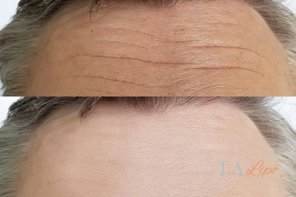 results of HIFU Byfleet on mans forehead to help reduce lines and wrinkles