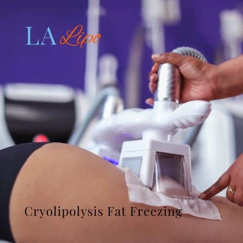 fat freezing - Cryolipolysis Byfleet