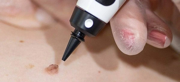 skin tag removal using cryopen Byfleet
