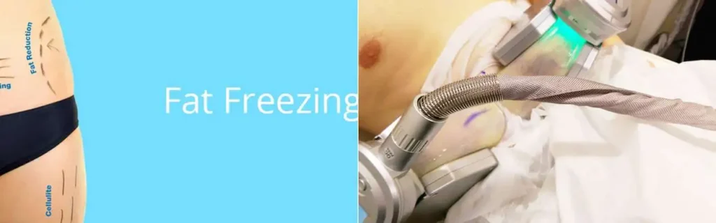 Fat freezing Byfleet on multiple areas of the body