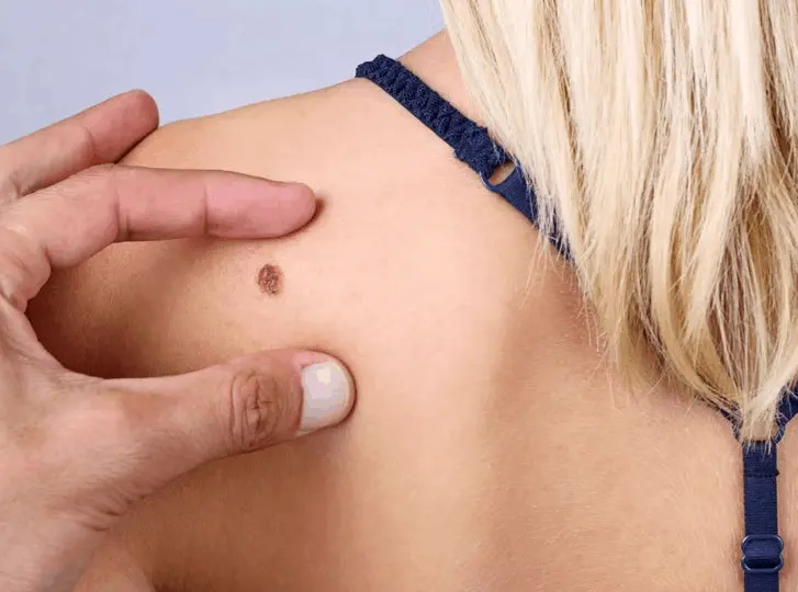 woman having mole removal Byfleet consultation before treatment.