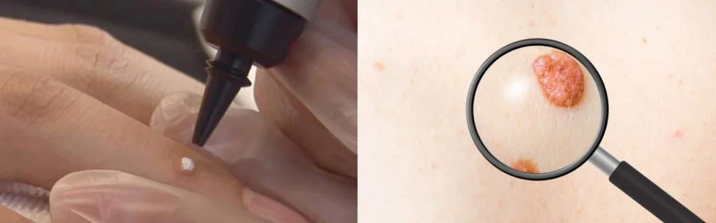 Person getting moles removed with cryopen Byfleet