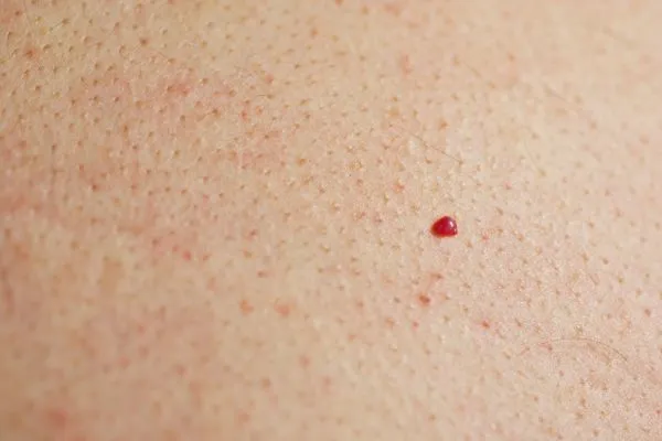 close up of a cherry angioma Byfleet