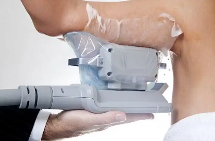 Picture of fat freezing Byfleet on the upper arms.