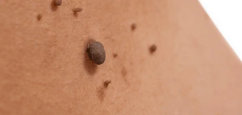 image of a skin tag Byfleet