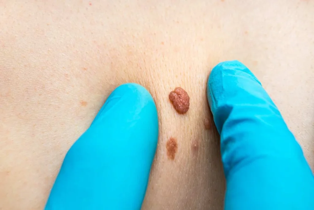 Consultant examining a skin tag Byfleet