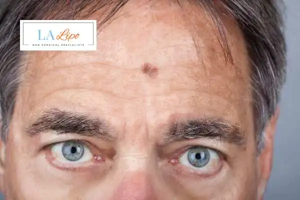 Solar Lentigo Removal Byfleet image of man with mark on his forehead