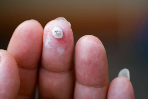 wart on person finger - cryotherapy to treat from LA LIPO Byfleet