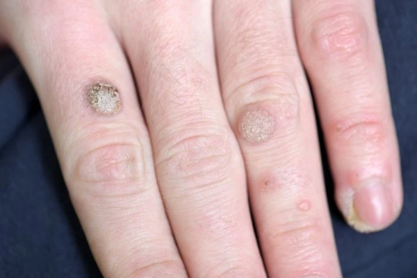 photo of warts on person hand - see wart removal Byfleet from LA LIPO