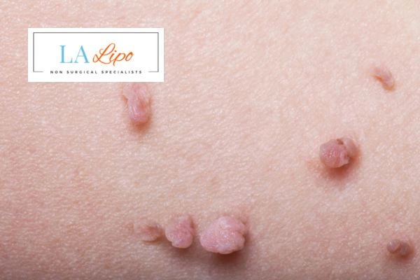 Does cryopen skin tag removal Byfleet hurt? Find out now call our team today!
