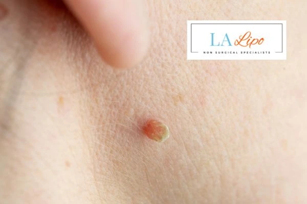 Book skin tag removal Byfleet today speak to our team now!