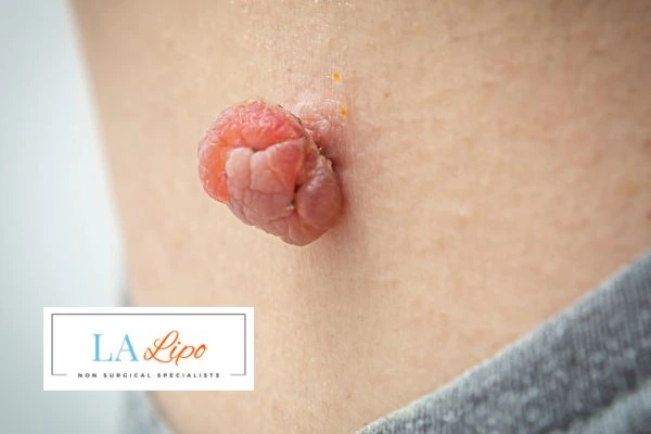 Interested in skin tag removal Byfleet? Concerned about the pain? Find out more today!