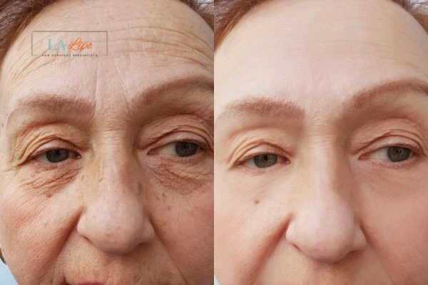 The powerful benefits of Morpheus8 Treatment Byfleet - Call Our team today!
