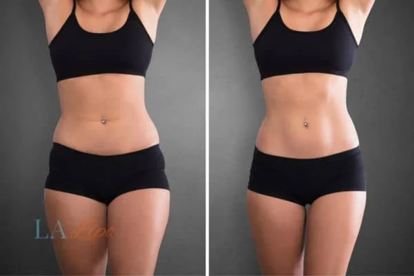 before and after results of non-surgical treatment to help a woman's body image and mental health Byfleet