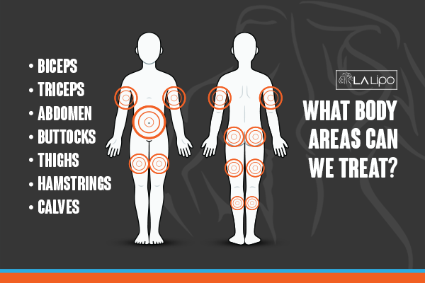 Diagram to show areas you can have LA-EMS Body Sculpting Treatment Byfleet