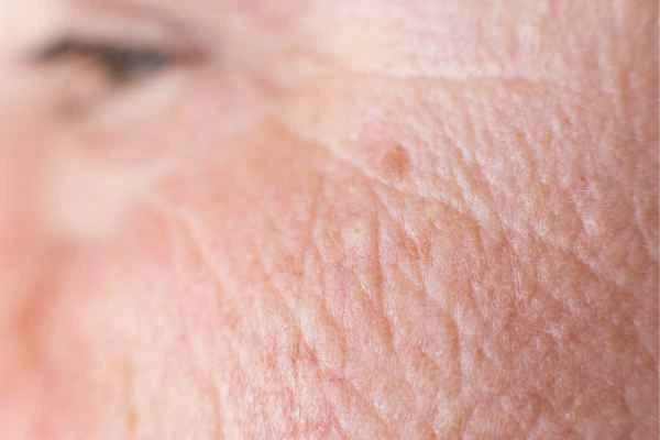 close up picture of a woman's face showing an age spot Byfleet