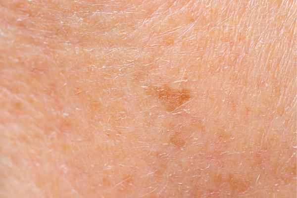 close up picture of age spots Byfleet