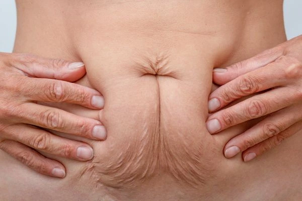 Image of a woman's stomach with loose skin - example of skin tightening Byfleet options