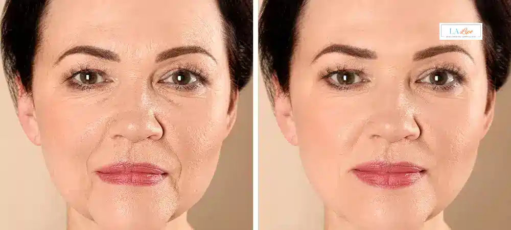 How Long Does It Take to See Results and How Long Do They Last Byfleet?