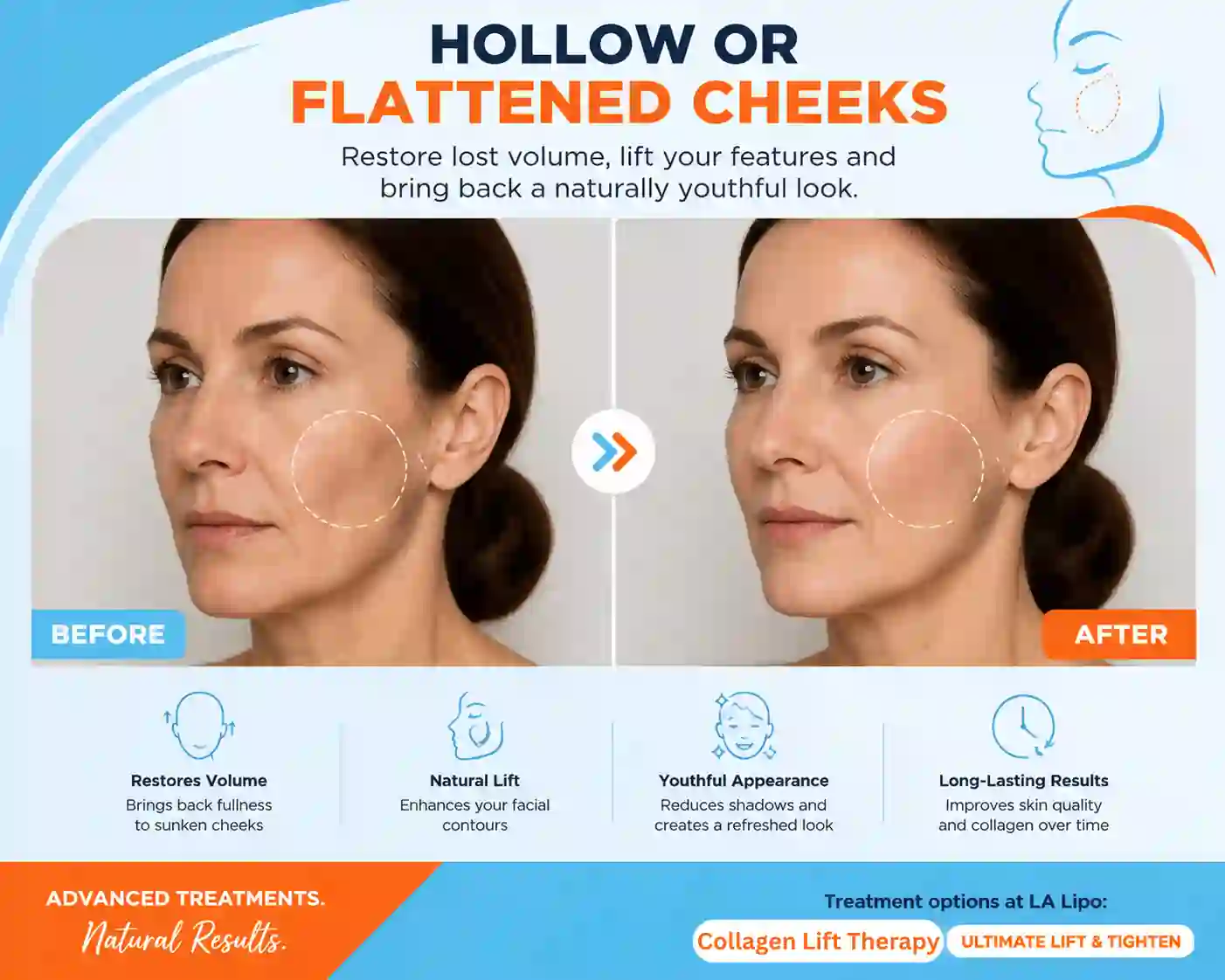 Sign #4: Hollow or Flattened Cheeks Byfleet